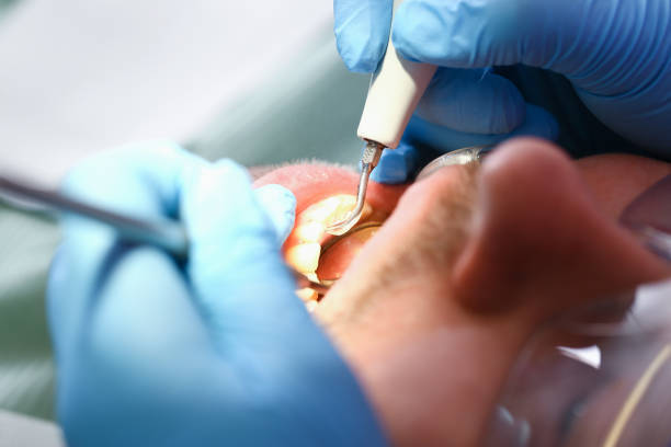 Best Emergency Dental Care for Broken or Chipped Teeth in Town N Country, FL