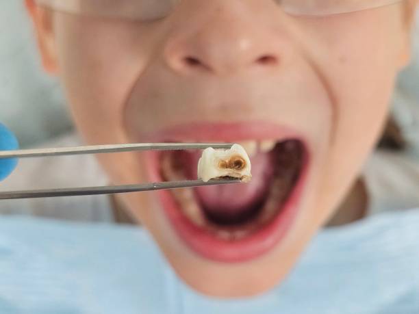 Best Emergency Tooth Extraction in Town N Country, FL