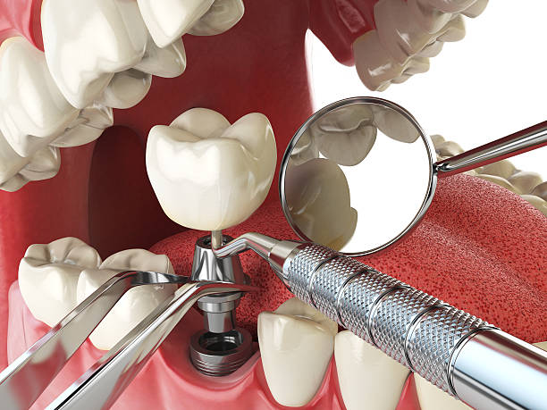 Best Emergency Wisdom Teeth Removal in Town N Country, FL