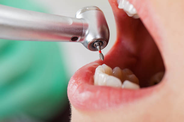 Best Emergency Dental Care for Broken or Chipped Teeth in Town N Country, FL